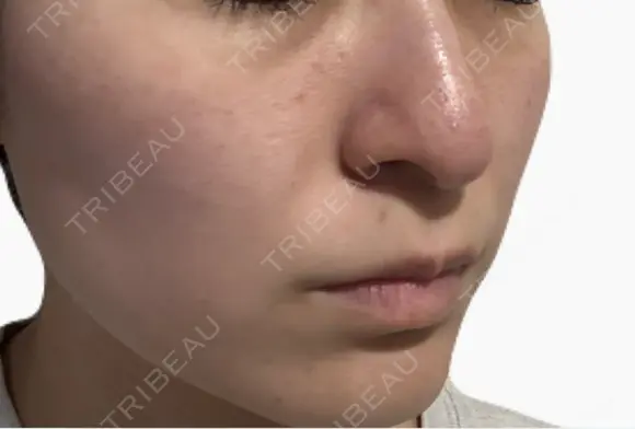 美肌レーザー / シミ取りレーザー / 美白レーザー / エレクトロポレーション / 毛穴洗浄（ハイドラフェイシャルなど） / ピコレーザートーニング（美白・肝斑） / フラクショナルレーザー（毛穴・ニキビ跡） / レーザートーニング（美白・肝斑） Fellez Clinic【フェルズクリニック】 DAY 6 メイン用