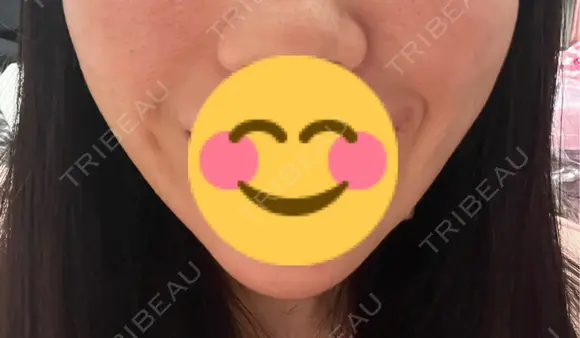 その他（口元） 川崎かかりつけクリニック AFTER メイン用