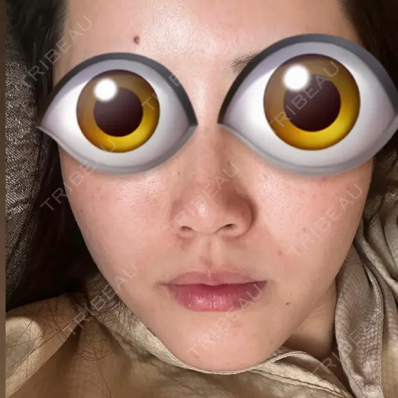 毛穴洗浄（ハイドラフェイシャルなど） / ピーリング（ハリ・ツヤ） KARIS beauty clinic DAY 4 メイン用