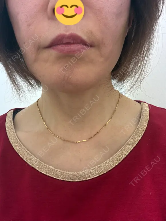 ヒアルロン酸注入（あご） / ヒアルロン酸注入（頬） / ヒアルロン酸注入（鼻翼基部） フローラクリニック AFTER メイン用