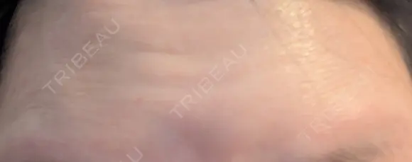 ボトックス（額） ルラライト美容クリニック 八王子院 DAY 8 メイン用