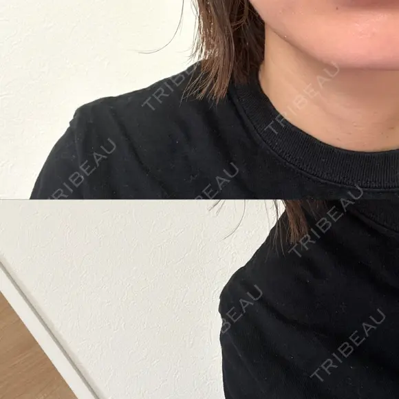 デンシティ 城本クリニック 新宿院 AFTER メイン用