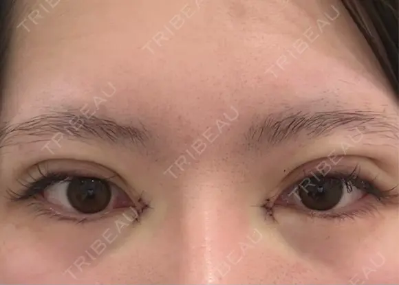 二重埋没 / 目頭切開 / 自然癒着法 Brandnew Beauty Clinic DAY 0 メイン用
