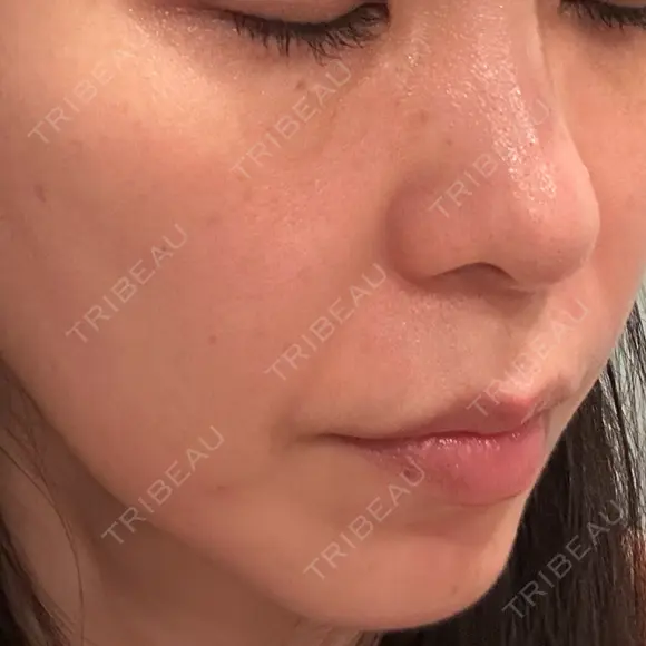 糸リフト / ボトックス（エラ・小顔） / ボトックス（額） / ボトックス（バニーライン） / ピコレーザートーニング（美白・肝斑） / ショッピングリフト APスキンクリニック銀座 DAY 67 メイン用