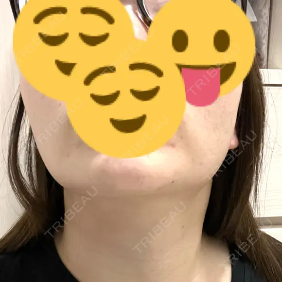 インモード おおかみ美容のクリニック 新宿院 AFTER メイン用