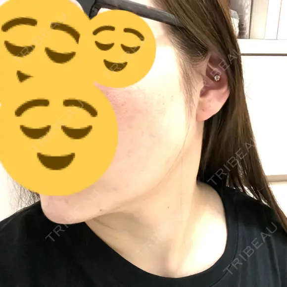 インモード おおかみ美容のクリニック 新宿院 DAY 6 メイン用