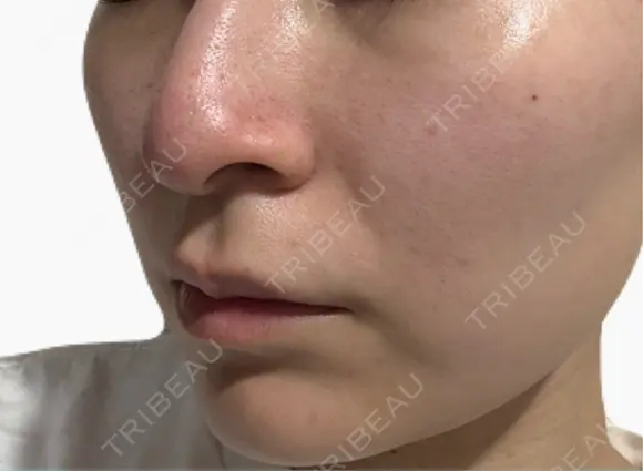 美肌レーザー / シミ取りレーザー / 美白レーザー / エレクトロポレーション / 毛穴洗浄（ハイドラフェイシャルなど） / ピコレーザートーニング（美白・肝斑） / フラクショナルレーザー（毛穴・ニキビ跡） / レーザートーニング（美白・肝斑） Fellez Clinic【フェルズクリニック】 DAY 7 メイン用