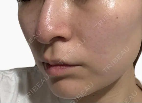 美肌レーザー / シミ取りレーザー / 美白レーザー / エレクトロポレーション / 毛穴洗浄（ハイドラフェイシャルなど） / ピコレーザートーニング（美白・肝斑） / フラクショナルレーザー（毛穴・ニキビ跡） / レーザートーニング（美白・肝斑） Fellez Clinic【フェルズクリニック】 DAY 8 メイン用