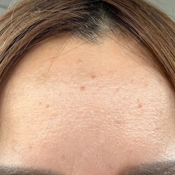 ボトックス（額） ルラ美容クリニック 郡山院 DAY 7 メイン用