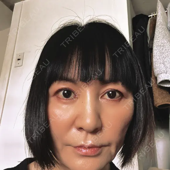 ヒアルロン酸注入（あご） / その他（輪郭） eクリニック 那覇院 DAY 20 メイン用