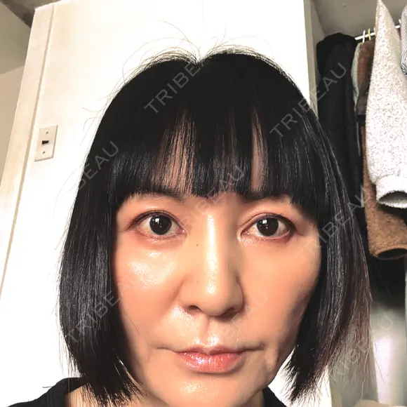 ヒアルロン酸注入（あご） / その他（輪郭） eクリニック 那覇院 AFTER メイン用