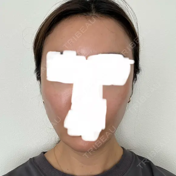 ボトックス（エラ・小顔） / ヒアルロン酸注入（額） / ヒアルロン酸注入（頬） / デンシティ フィラークリニック 新宿院 DAY 1 メイン用