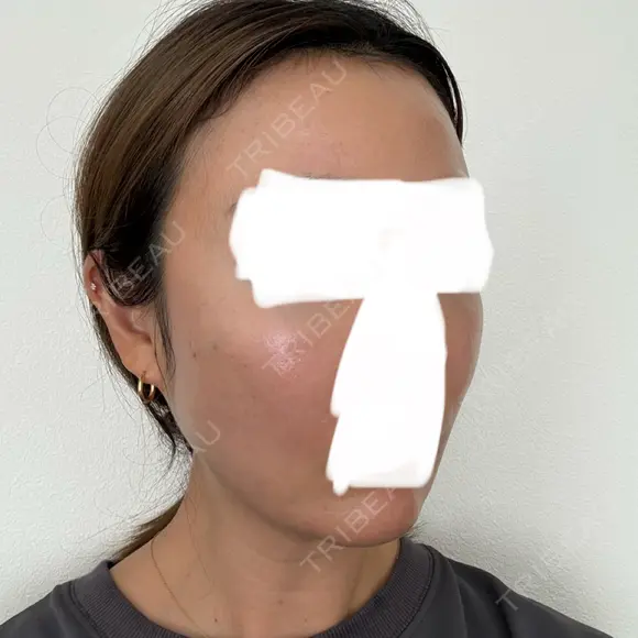 ボトックス（エラ・小顔） / ヒアルロン酸注入（額） / ヒアルロン酸注入（頬） / デンシティ フィラークリニック 新宿院 DAY 1 メイン用