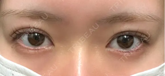 二重埋没 EMMA CLINIC（エマクリニック） AFTER メイン用