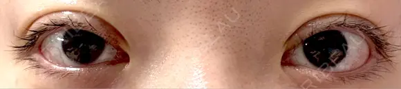 二重切開 EMMA CLINIC（エマクリニック） AFTER メイン用
