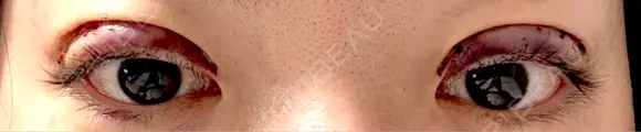 二重切開 EMMA CLINIC（エマクリニック） DAY 0 メイン用