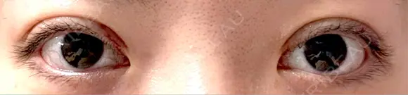 二重切開 EMMA CLINIC（エマクリニック） DAY 14 メイン用