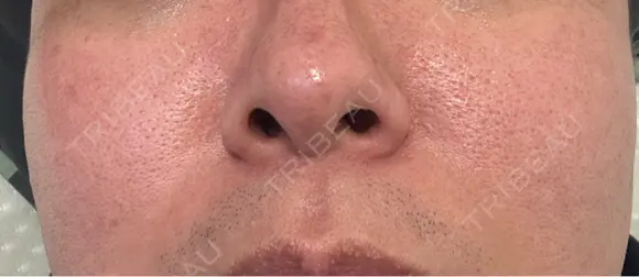 美肌レーザー / シミ取りレーザー / 美白レーザー / エレクトロポレーション / 毛穴洗浄（ハイドラフェイシャルなど） / ピコレーザートーニング（美白・肝斑） / フラクショナルレーザー（毛穴・ニキビ跡） / レーザートーニング（美白・肝斑） Fellez Clinic【フェルズクリニック】 DAY 0 メイン用