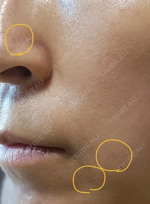 ほくろ・いぼ切除（肌） CLINIC W AFTER メイン用