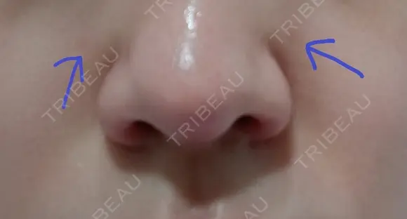 隆鼻術 / 鼻尖形成（切開） / 鼻中隔延長（切開） / 軟骨移植 / 骨切幅寄せ / 鼻孔縁挙上 / 鼻翼基部形成（貴族手術） / 鼻柱下降・鼻唇角形成（猫手術） WOM CLINIC GINZA （ワム クリニック ギンザ） AFTER メイン用