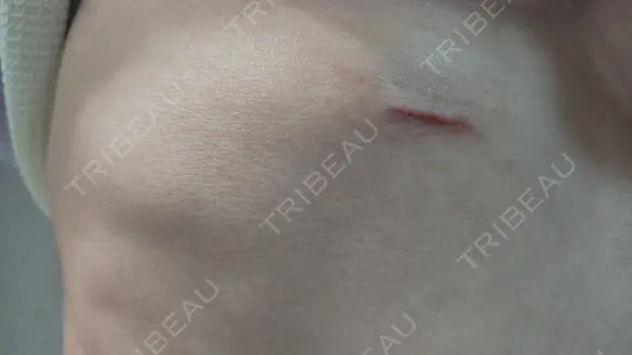 隆鼻術 / 鼻尖形成（切開） / 鼻中隔延長（切開） / 軟骨移植 / 骨切幅寄せ / 鼻孔縁挙上 / 鼻翼基部形成（貴族手術） / 鼻柱下降・鼻唇角形成（猫手術） WOM CLINIC GINZA （ワム クリニック ギンザ） DAY 38 メイン用