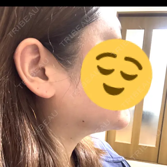 インモード PureMe Skin Clinic（ピュアミースキンクリニック麻布） AFTER メイン用