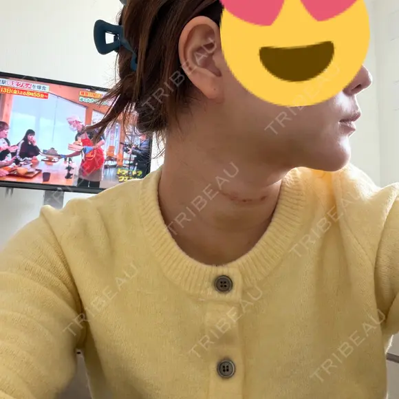糸リフト / 脂肪吸引（顔） 4Dクリニック DAY 14 メイン用
