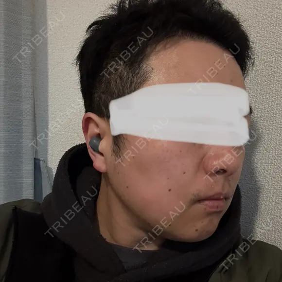 脂肪溶解注射（顔） 上野注入クリニック DAY 4 メイン用