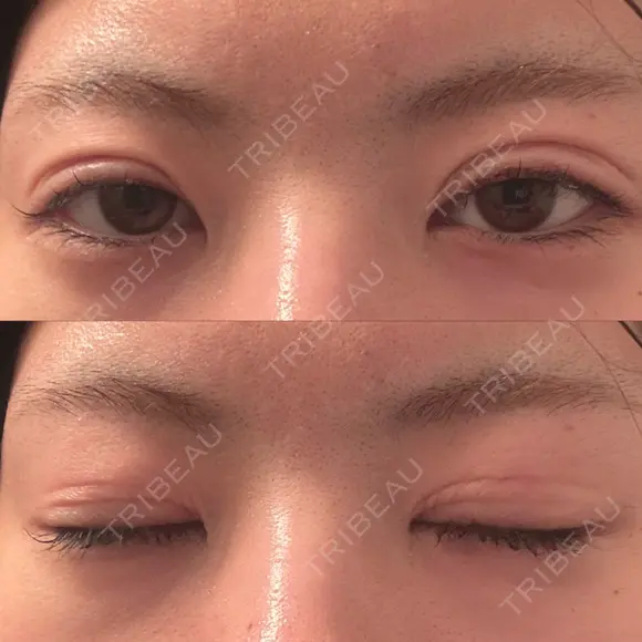 二重埋没 形成外科と美容外科のクリニック池袋 AFTER メイン用