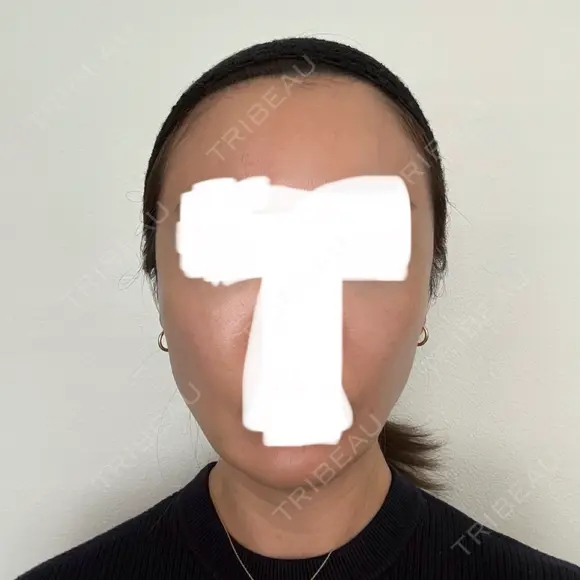 ボトックス（エラ・小顔） / ヒアルロン酸注入（額） / ヒアルロン酸注入（頬） / デンシティ フィラークリニック 新宿院 DAY 3 メイン用