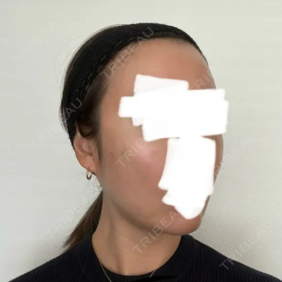 ボトックス（エラ・小顔） / ヒアルロン酸注入（額） / ヒアルロン酸注入（頬） / デンシティ フィラークリニック 新宿院 DAY 3 メイン用