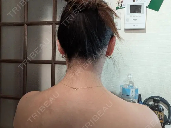 ボトックス（肩） eクリニック 横浜みなとみらい院 AFTER メイン用