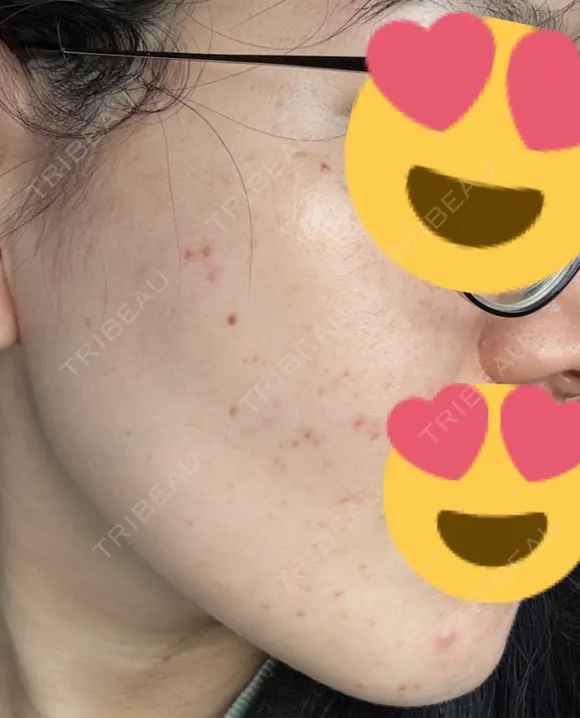 美肌レーザー / LDM・インテンスウルトラ ライズワン美容皮膚科クリニック AFTER メイン用