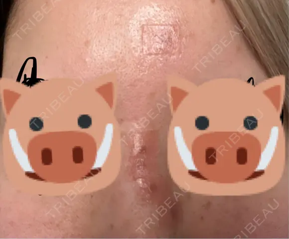 シミ取りレーザー eクリニック 金沢本院 DAY 10 メイン用