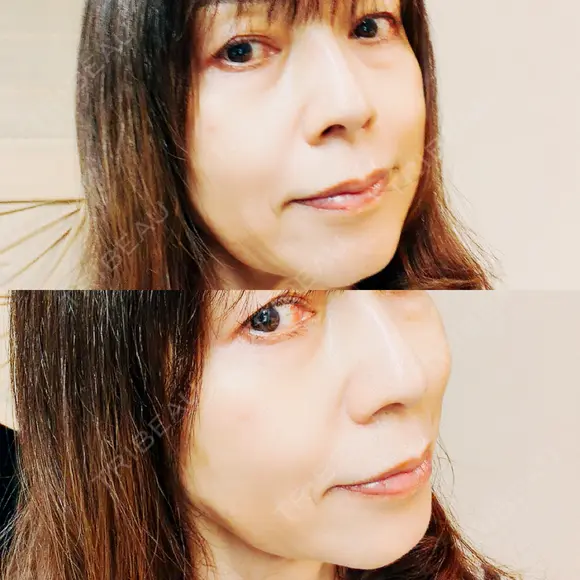 インモード / オンダリフト RIVER CLINIC（リバークリニック） DAY 11 メイン用