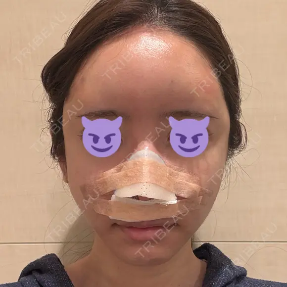 鼻尖形成（切開） / 軟骨移植 / 脂肪注入（額） / 鼻翼基部形成（貴族手術） eクリニック 福岡院 DAY 1 メイン用