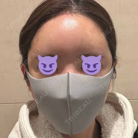 鼻尖形成（切開） / 軟骨移植 / 脂肪注入（額） / 鼻翼基部形成（貴族手術） eクリニック 福岡院 DAY 2 メイン用