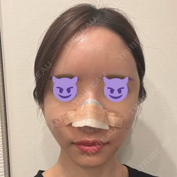 鼻尖形成（切開） / 軟骨移植 / 脂肪注入（額） / 鼻翼基部形成（貴族手術） eクリニック 福岡院 DAY 4 メイン用