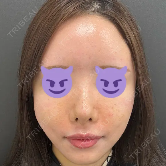 鼻尖形成（切開） / 軟骨移植 / 脂肪注入（額） / 鼻翼基部形成（貴族手術） eクリニック 福岡院 DAY 7 メイン用