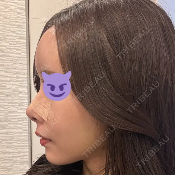 鼻尖形成（切開） / 軟骨移植 / 脂肪注入（額） / 鼻翼基部形成（貴族手術） eクリニック 福岡院 DAY 9 メイン用