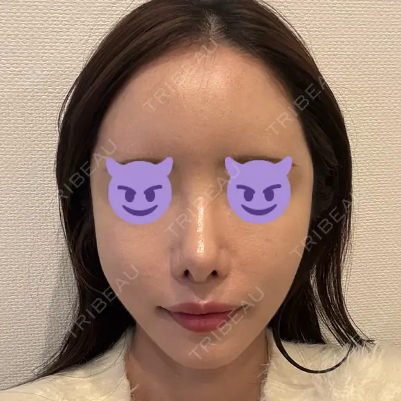 鼻尖形成（切開） / 軟骨移植 / 脂肪注入（額） / 鼻翼基部形成（貴族手術） eクリニック 福岡院 DAY 13 メイン用
