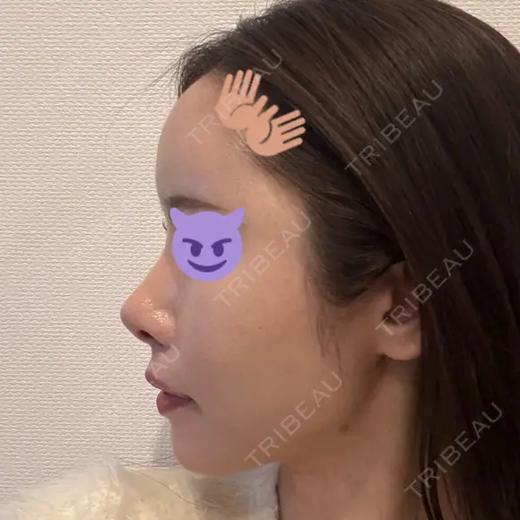 鼻尖形成（切開） / 軟骨移植 / 脂肪注入（額） / 鼻翼基部形成（貴族手術） eクリニック 福岡院 DAY 13 メイン用