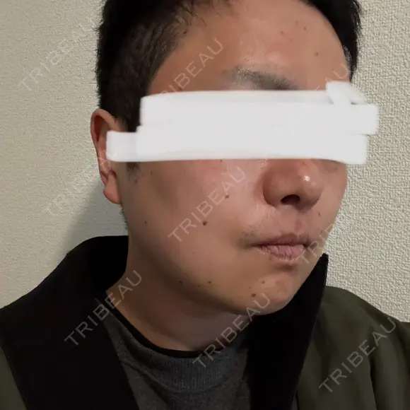 脂肪溶解注射（顔） 上野注入クリニック DAY 6 メイン用