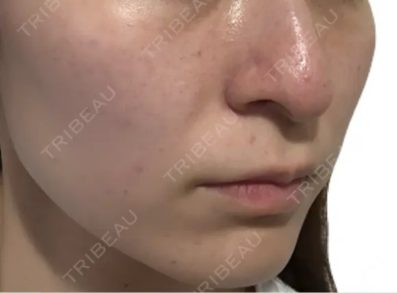 美肌レーザー / シミ取りレーザー / 美白レーザー / エレクトロポレーション / 毛穴洗浄（ハイドラフェイシャルなど） / ピコレーザートーニング（美白・肝斑） / フラクショナルレーザー（毛穴・ニキビ跡） / レーザートーニング（美白・肝斑） Fellez Clinic【フェルズクリニック】 AFTER メイン用