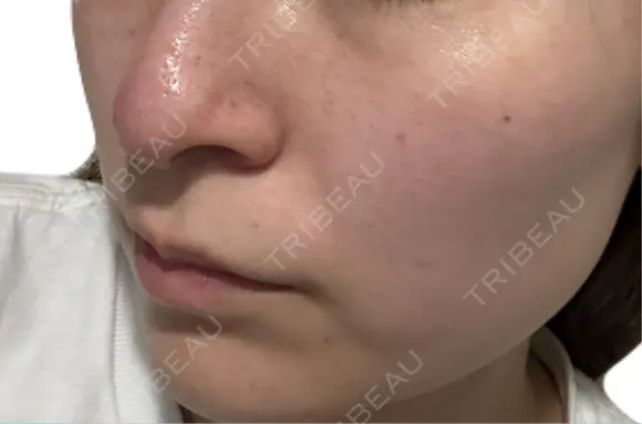 美肌レーザー / シミ取りレーザー / 美白レーザー / エレクトロポレーション / 毛穴洗浄（ハイドラフェイシャルなど） / ピコレーザートーニング（美白・肝斑） / フラクショナルレーザー（毛穴・ニキビ跡） / レーザートーニング（美白・肝斑） Fellez Clinic【フェルズクリニック】 DAY 10 メイン用