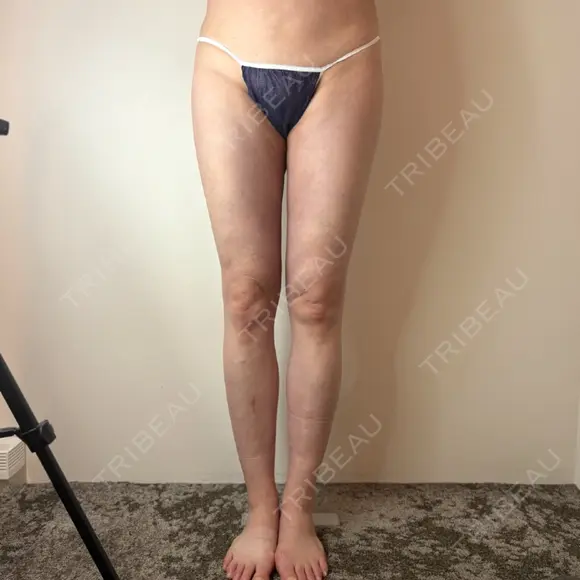 脂肪吸引（脚） / 脂肪吸引（お尻） / 脂肪吸引（腰） GAYA body design clinic DAY 35 メイン用