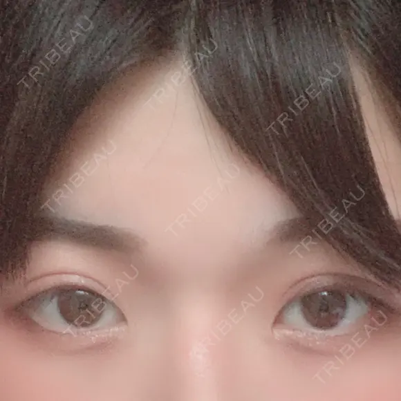 二重切開 / 眼瞼下垂（切開） 広島プルミエクリニック DAY 92 メイン用