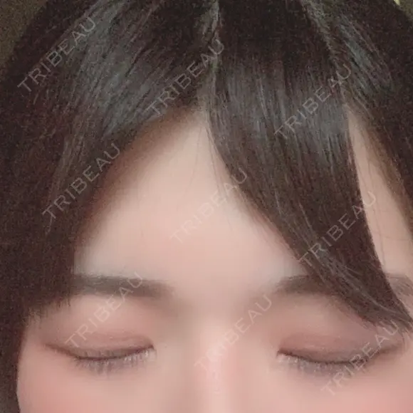 二重切開 / 眼瞼下垂（切開） 広島プルミエクリニック DAY 92 メイン用