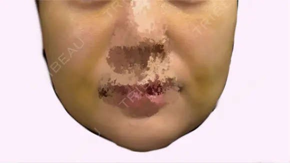 糸リフト / メーラーファット除去 4Dクリニック DAY 5 メイン用