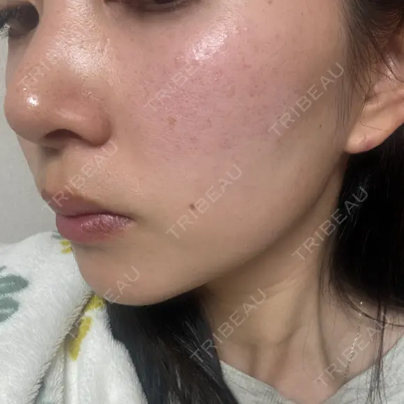 イオン導入 / 毛穴洗浄（ハイドラフェイシャルなど） / ルメッカ ルラ美容クリニック 岡山院 AFTER メイン用